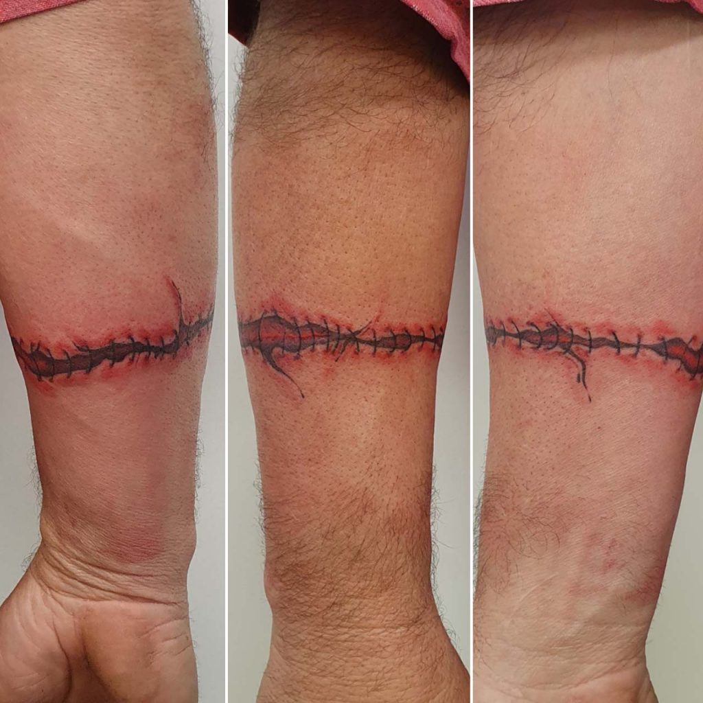 Stitches tattoo – Dan – Kingaroy