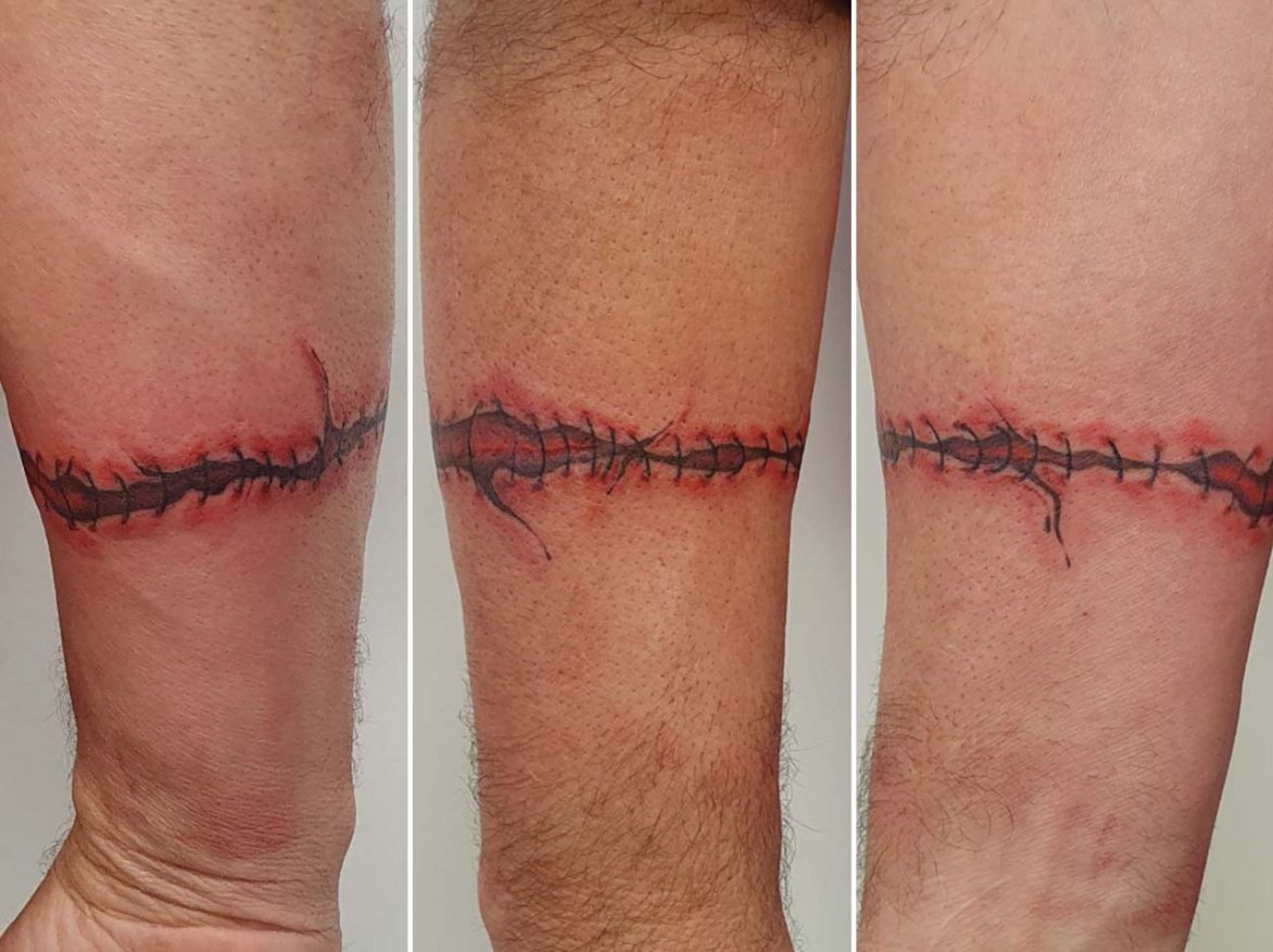 Stitches tattoo - Dan - Kingaroy